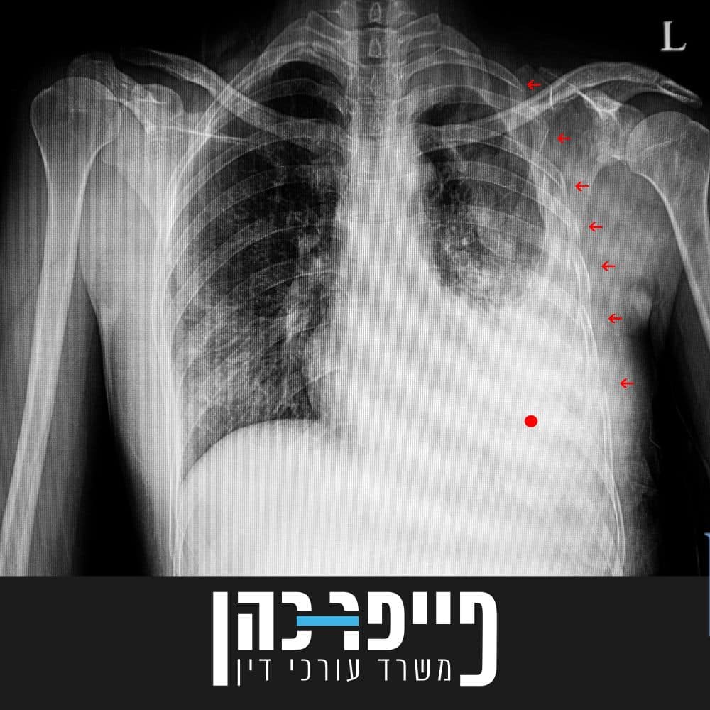 תביעה בגין שברים בצלעות עקב תאונת דרכים